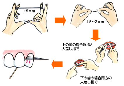 ピンと張った糸で歯の側面のプラークを除去する方法を解説しているフロー図
