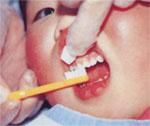 子どもの歯に歯ブラシでフッ化物を塗っている様子の写真