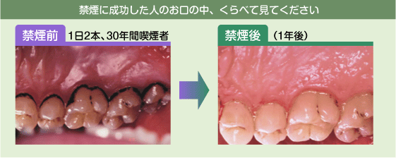 禁煙委成功した人の口の中のを比べた説明フロー図