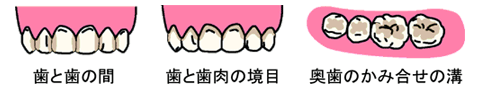 歯と歯の間、歯と歯肉の境目、奥歯のかみ合わせの溝のイラスト