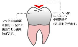 虫歯予防のイラスト説明図