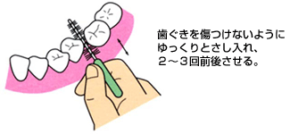 歯間ブラシの使い方のイラスト説明図