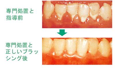 歯石除去の効果