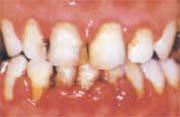 歯周炎の歯肉の様子の写真
